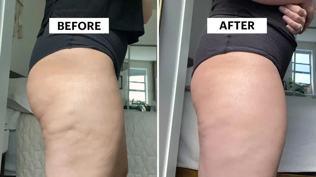 Do Toning Exercise Uxbridge Really Tackle Cellulite?